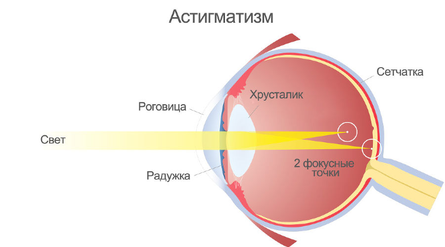 Двоение в глазах — причины, диагностика, что делать если кружится голова и двоится в глазах